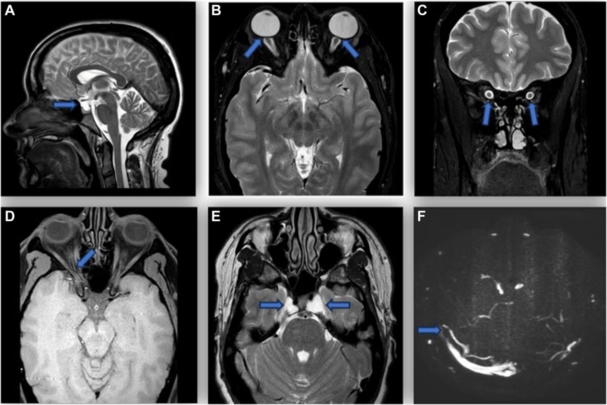 How Neuroradiology Aids in Diagnosing Vision-related Brain Disorders